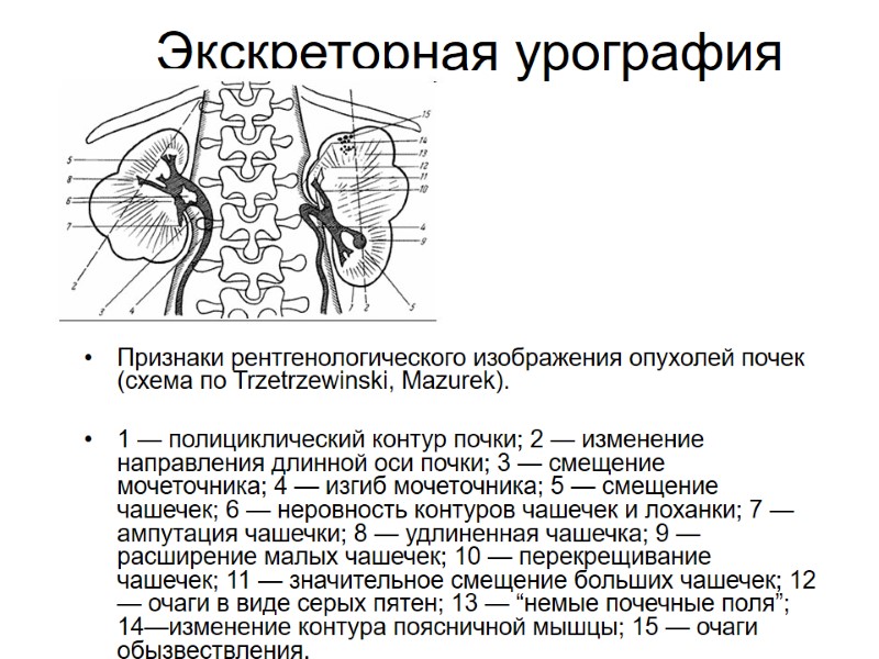 Экскреторная урография Признаки рентгенологического изображения опухолей почек (схема по Trzetrzewinski, Mazurek).  1 —